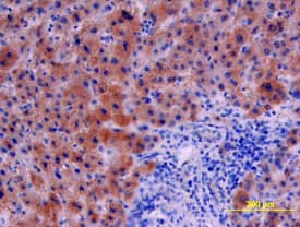 Serpin E1/PAI-1 antibody in Human Liver Cancer Tissue by Immunohistochemistry (IHC-P).