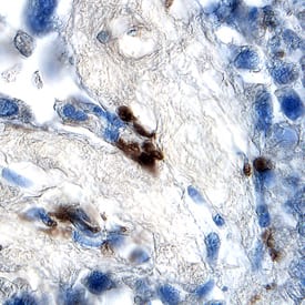 Smad2 antibody in Human Pancreatic Cancer Tissue by Immunohistochemistry (IHC-P).