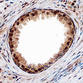 Smad9 antibody in Human Prostate Cancer Tissue by Immunohistochemistry (IHC-P).