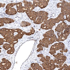 Smoothened antibody in Human Liver Cancer Tissue by Immunohistochemistry (IHC-P).