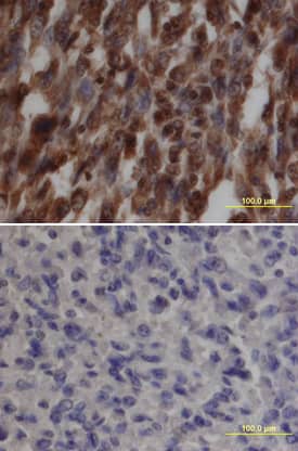 Src antibody in Human Liver Cancer Tissue by Immunohistochemistry (IHC-P).