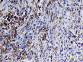 Src antibody in Human Liver Cancer Tissue by Immunohistochemistry (IHC-P).