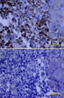 Src antibody in Human Lung Cancer Tissue by Immunohistochemistry (IHC-P).