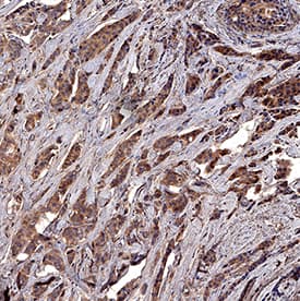 Survivin antibody in Human Breast Cancer Tissue by Immunohistochemistry (IHC-P).