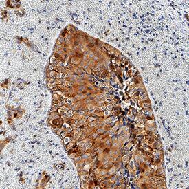 Survivin antibody in Human Breast Cancer Tissue by Immunohistochemistry (IHC-P).