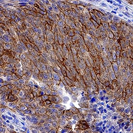 Syndecan-1/CD138 antibody in Human Cervical Cancer Tissue by Immunohistochemistry (IHC-P).