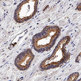 TBK1 antibody in Human Prostate Cancer Tissue by Immunohistochemistry (IHC-P).