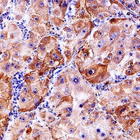 TEM8/ANTXR1 antibody in Human Liver Cancer Tissue by Immunohistochemistry (IHC-P).