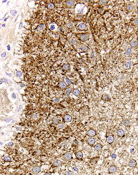 TGF-a antibody in Human Astrocytoma by Immunohistochemistry (IHC-P).