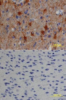 TGF-a antibody in Human Astrocytoma by Immunohistochemistry (IHC-P).