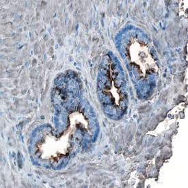 TGF-beta 2 antibody in Human Prostate Cancer by Immunohistochemistry (IHC-P).