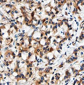 TGF-beta 3 antibody in Human Breast Cancer Tissue by Immunohistochemistry (IHC-P).