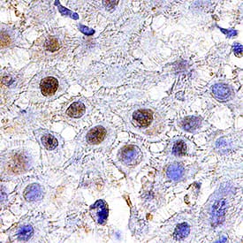 TGIF1 antibody in Human Squamous Cell Carcinoma by Immunohistochemistry (IHC-P).