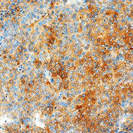TIGAR/C12orf5 antibody in Human Breast Cancer Tissue by Immunohistochemistry (IHC-P).
