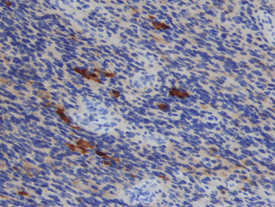 TIMP-1 antibody in Human Astrocytoma by Immunohistochemistry (IHC-P).