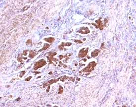 TIMP-2 antibody in Human Ovarian Cancer Tissue by Immunohistochemistry (IHC-P).