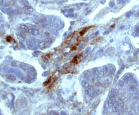 TIMP-2 antibody in Human Ovarian Cancer Tissue by Immunohistochemistry (IHC-P).