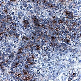 TIMP-1 antibody in Human Colon Cancer Tissue by Immunohistochemistry (IHC-P).