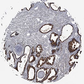 TL1A/TNFSF15 antibody in Human Prostate Cancer Tissue by Immunohistochemistry (IHC-P).