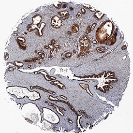 TL1A/TNFSF15 antibody in Human Prostate Cancer Tissue by Immunohistochemistry (IHC-P).