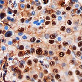 TLE2 antibody in Human Lung Mesothelioma by Immunohistochemistry (IHC-P).