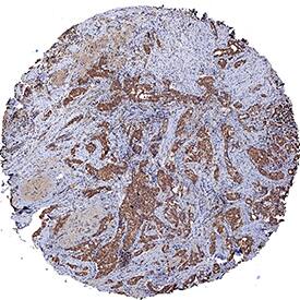 TM4SF1/L6 antibody in Human Breast Cancer Tissue by Immunohistochemistry (IHC-P).