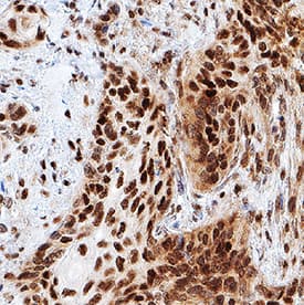 TOR antibody in Human Squamous Cell Carcinoma by Immunohistochemistry (IHC-P).