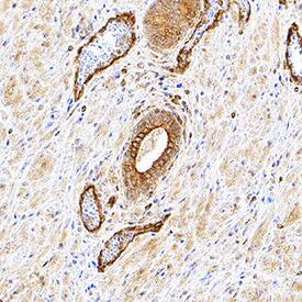 TRAIL/TNFSF10 antibody in Human Prostate Cancer Tissue by Immunohistochemistry (IHC-P).