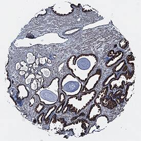 TRIM32 antibody in Human Prostate Cancer Tissue by Immunohistochemistry (IHC-P).