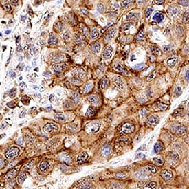 TROP-2 antibody in Human Cervical Cancer Tissue by Immunohistochemistry (IHC-P).