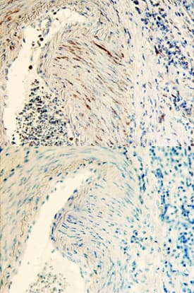 Tsukushi/TSK antibody in Human Colon Cancer Tissue by Immunohistochemistry (IHC-P).