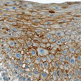 TTK antibody in Human Squamous Cell Carcinoma by Immunohistochemistry (IHC-P).