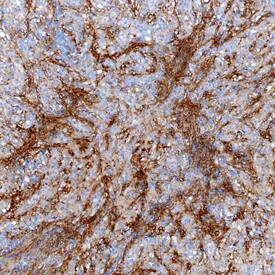 Tenascin X antibody in Human Lung Mesothelioma by Immunohistochemistry (IHC-P).
