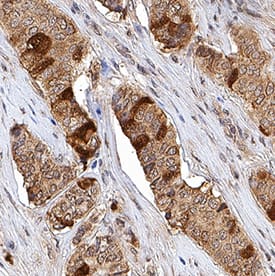 Thymidine Kinase 1 antibody in Human Breast Cancer Tissue by Immunohistochemistry (IHC-P).