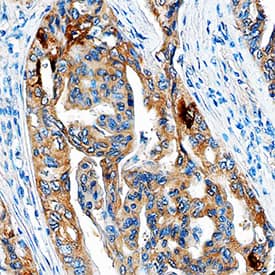 Thyroglobulin antibody in Human Thyroid Cancer Tissue by Immunohistochemistry (IHC-P).