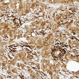 Transgelin/TAGLN antibody in Human Liver Cancer Tissue by Immunohistochemistry (IHC-P).
