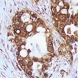 Trypsin antibody in Human Pancreatic Cancer Tissue by Immunohistochemistry (IHC-P).