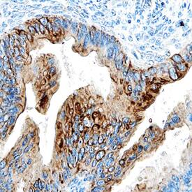 ULBP-4/RAET1E antibody in Human Ovarian Cancer Tissue by Immunohistochemistry (IHC-P).