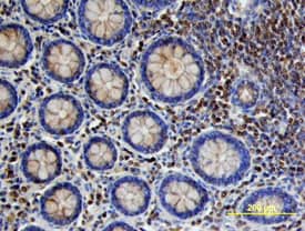 VEGF-C antibody in Human Colon Cancer Tissue by Immunohistochemistry (IHC-P).