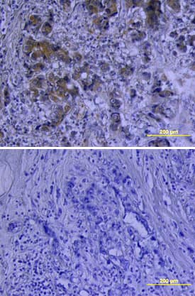 VEGF antibody in Human Breast Cancer Tissue by Immunohistochemistry (IHC-P).