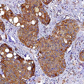 VEGF antibody in Human Liver Cancer Tissue by Immunohistochemistry (IHC-P).