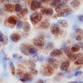 WDR5 antibody in Human B-Cell Lymphoma by Immunohistochemistry (IHC-P).