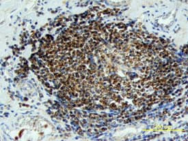 Wnt-6 antibody in Human Colon Cancer Tissue by Immunohistochemistry (IHC-P).