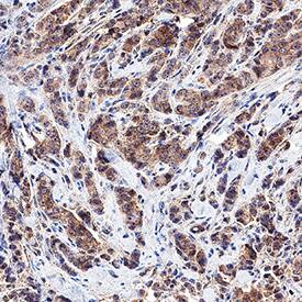 Wnt-4 antibody in Human Breast Cancer Tissue by Immunohistochemistry (IHC-P).