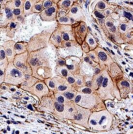 Wnt-4 antibody in Human Breast Cancer Tissue by Immunohistochemistry (IHC-P).