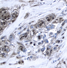 XIAP antibody in Human Breast Cancer Tissue by Immunohistochemistry (IHC-P).