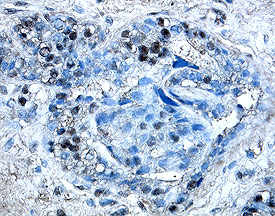 Yes antibody in Human Breast Cancer Tissue by Immunohistochemistry (IHC-P).