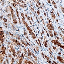 ZAG antibody in Human Breast Cancer Tissue by Immunohistochemistry (IHC-P).