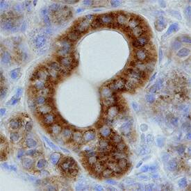 ZAP70 antibody in Human Lymphoma by Immunohistochemistry (IHC-P).