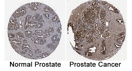 BMPR-IA/ALK-3 antibody in Human Prostate Cancer Tissue by Immunohistochemistry (IHC-P).